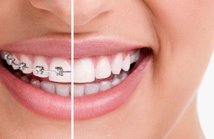 Invisalign vs. Braces