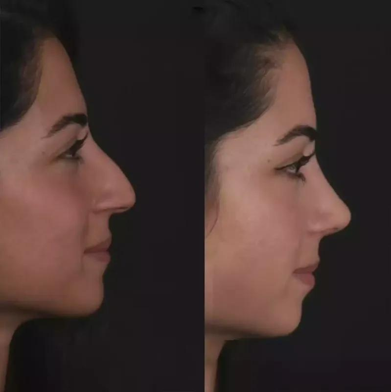 Dubai Rhinoplasty: Your Comprehensive Guide