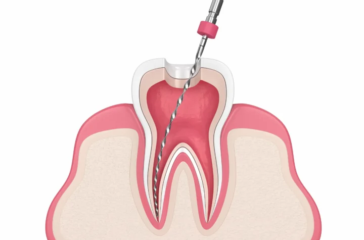 root canal obturation
