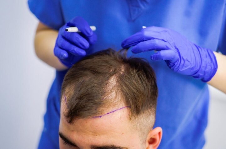 BEST SURGEON FOR HAIR TRANSPLANT IN ISLAMABAD PAKISTAN
