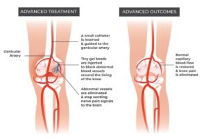 Genicular Artery Embolization