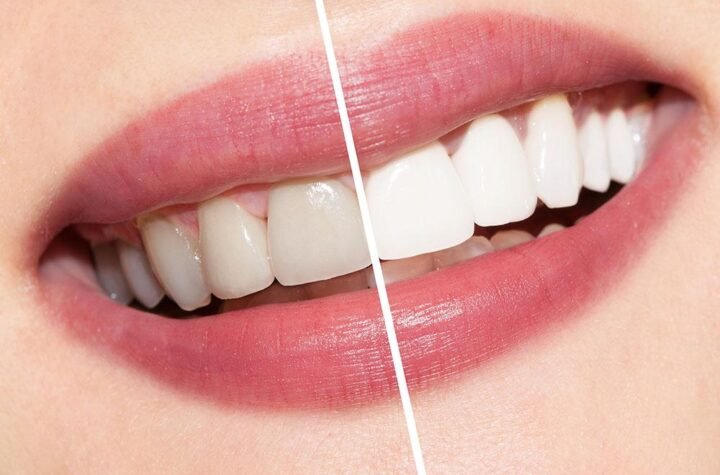 smile teeth whitening