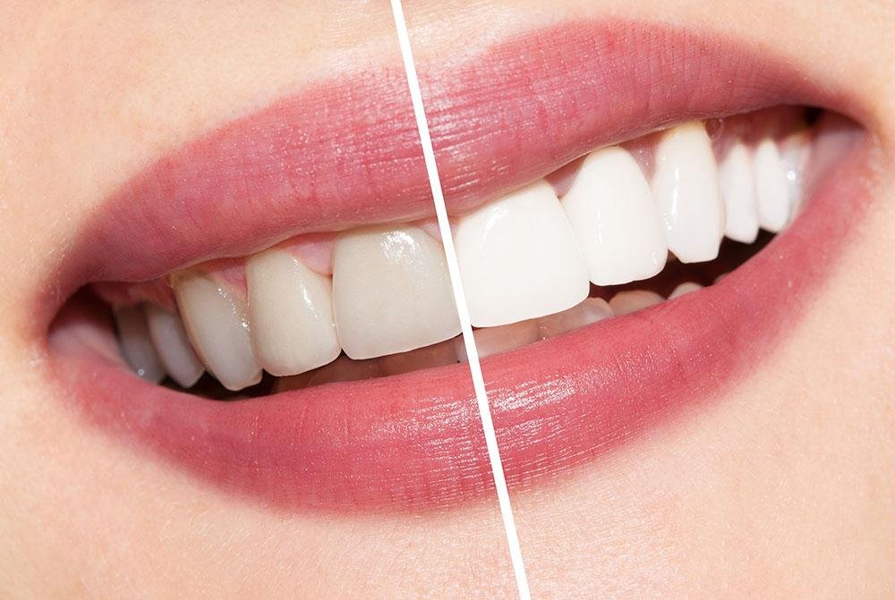 smile teeth whitening