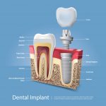 Dental Implants and Prosthetics Market to Grow at 10% CAGR Over the Next five Years