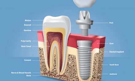 Dental Implants and Prosthetics Market to Grow at 10% CAGR Over the Next five Years