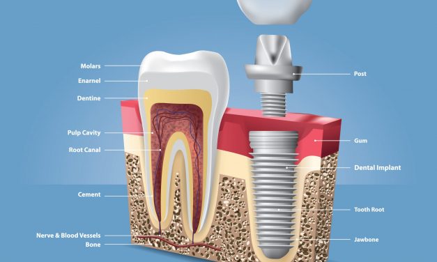 Dental Implants and Prosthetics Market to Grow at 10% CAGR Over the Next five Years