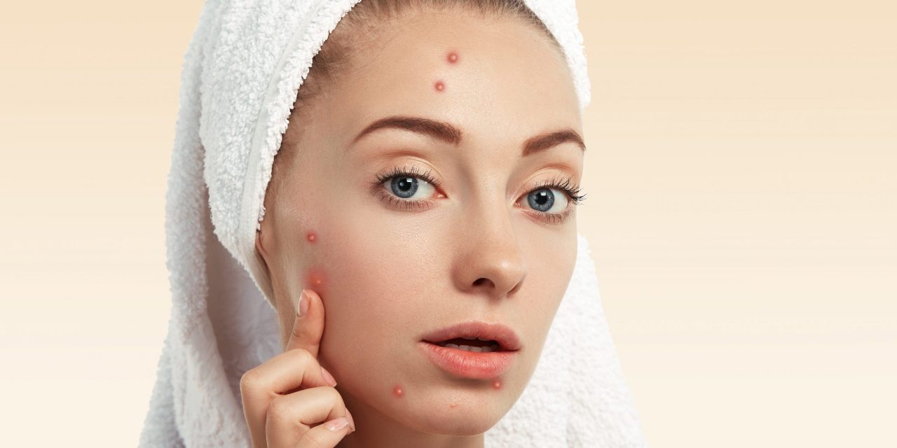 How to Get Rid of Acne quickly at Home?