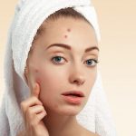 How to Get Rid of Acne quickly at Home?