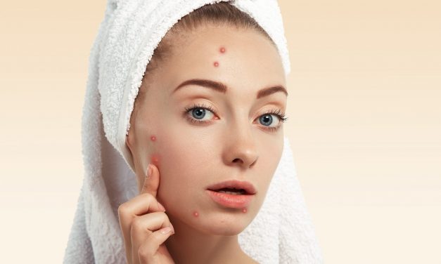 How to Get Rid of Acne quickly at Home?