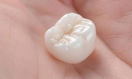 Porcelain Crowns: Step-by-Step What to Expect